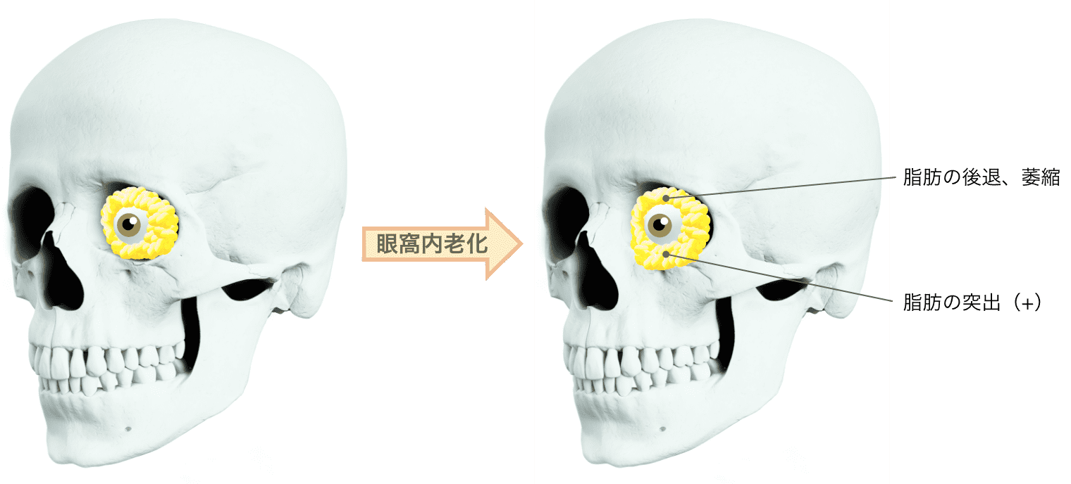 眼窩内廊下の説明図