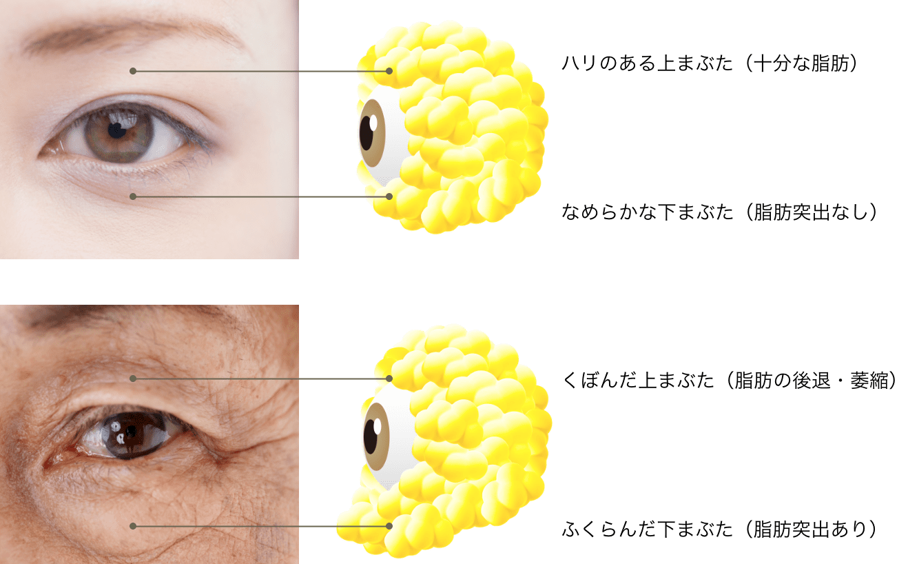 上まぶたのくぼみと下まぶたのふくら身の説明図