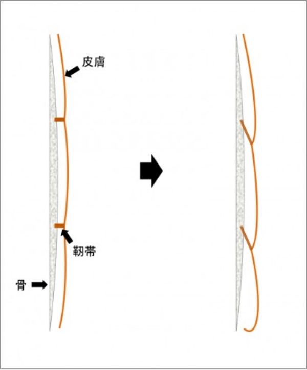 皮膚のたるみの説明図